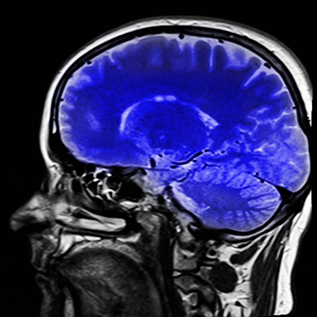 Imagerie cerveau